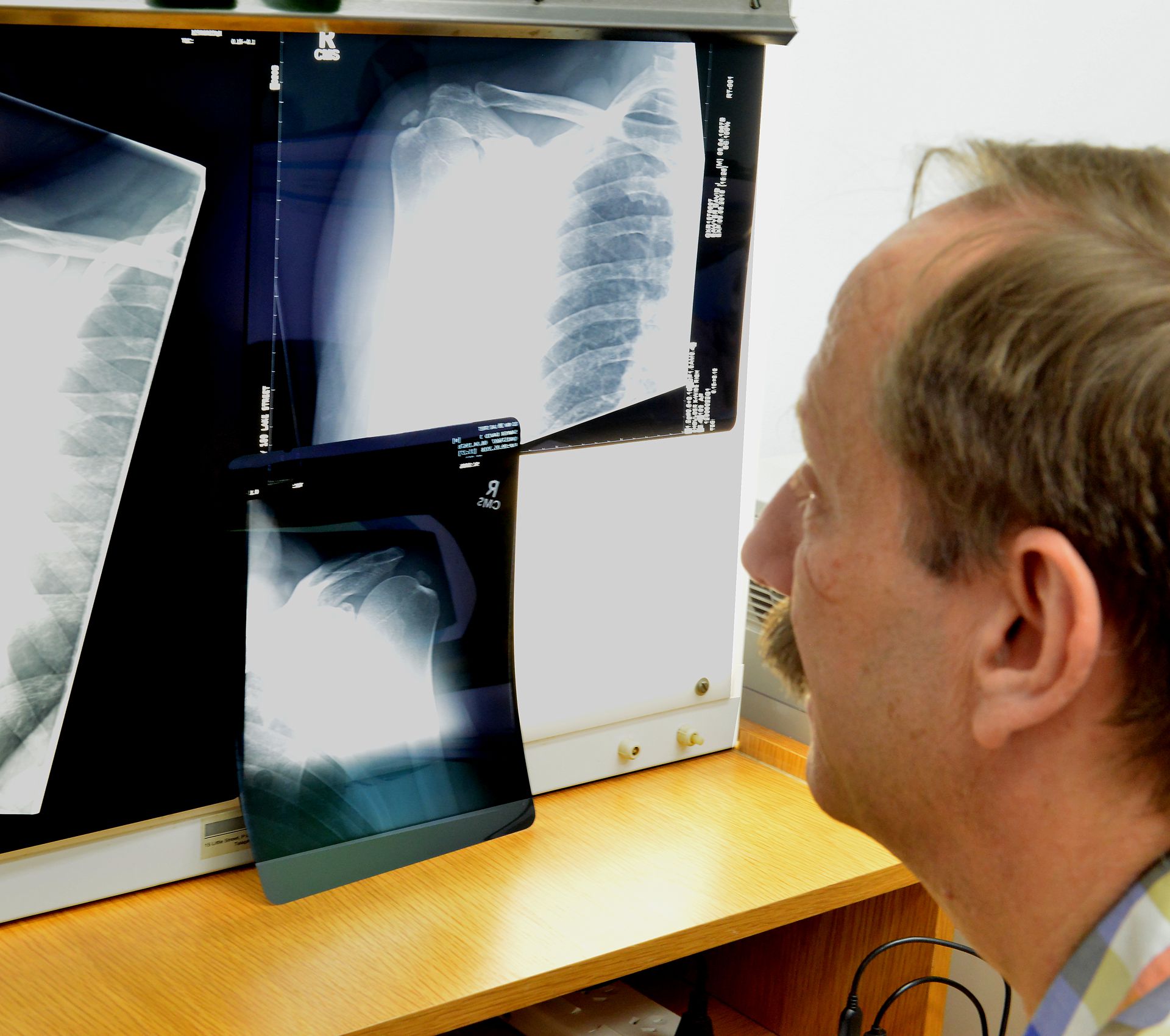 Cairns Shoulder Replacement